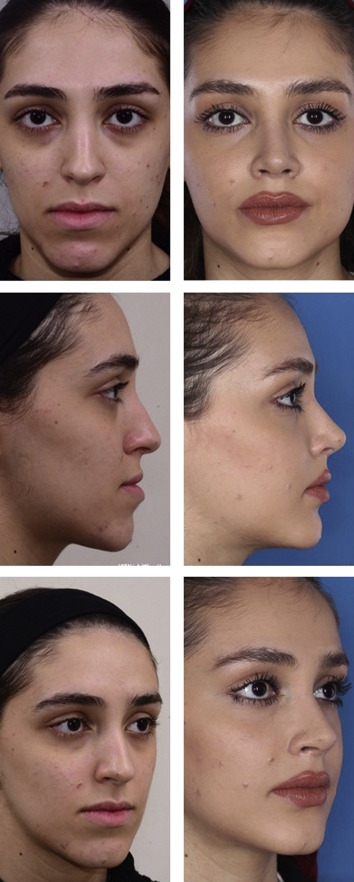 thick skin rhinoplasty expert