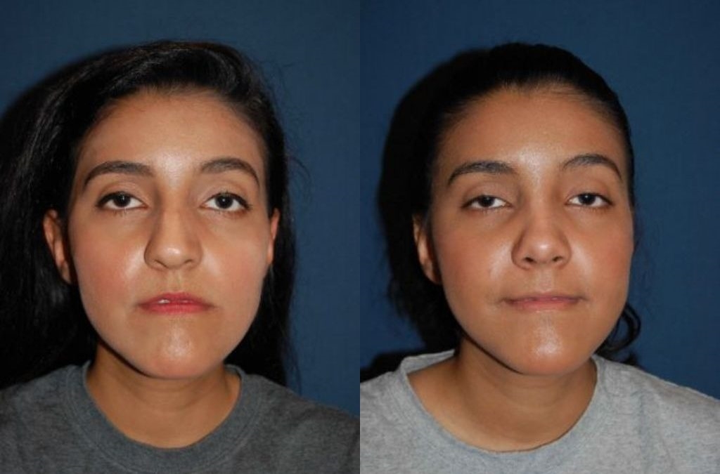 thick skin rhinoplasty expert