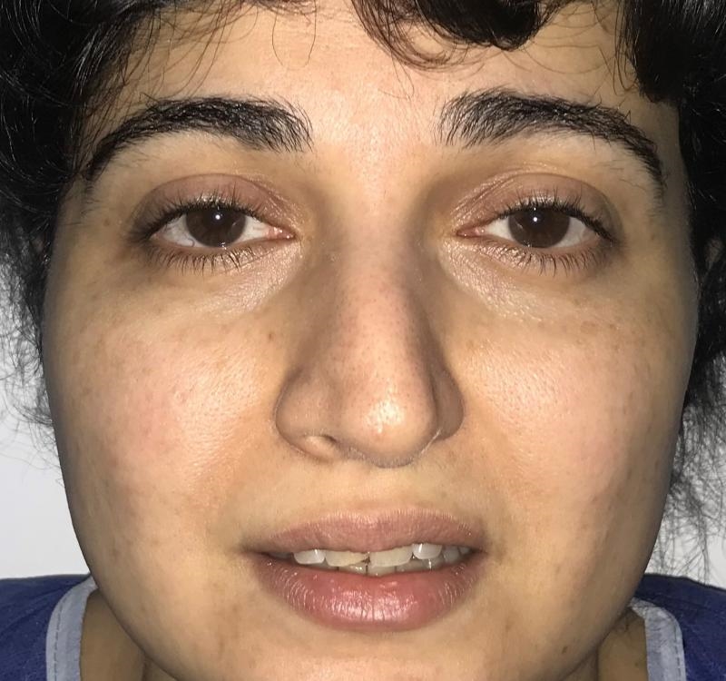 thick skin rhinoplasty expert