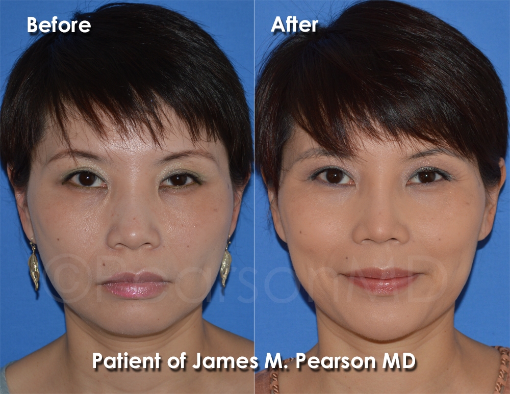 thick skin rhinoplasty expert
